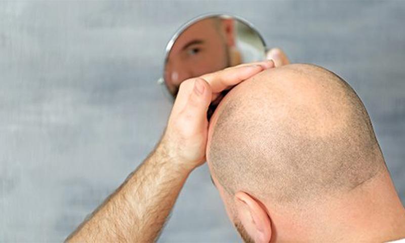 شروط زراعة الشعر: إليكم أبرزها